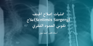 علاج تقوس العمود الفقري