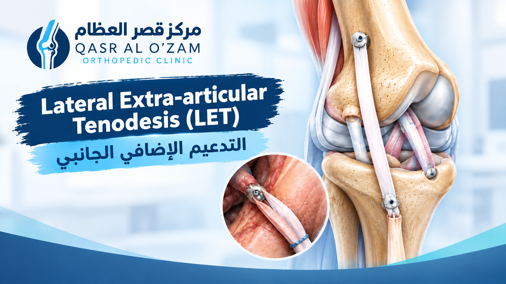 دكتور تخصص رباط صليبي: متى تحتاج إلى تقنية LET لتدعيم ثبات الركبة؟ دكتور تخصص رباط صليبي